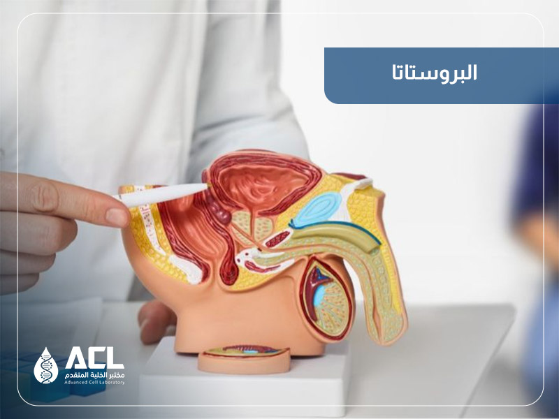 فحص البروستاتا | تحليل PSA وتشخيص تضخم البروستاتا