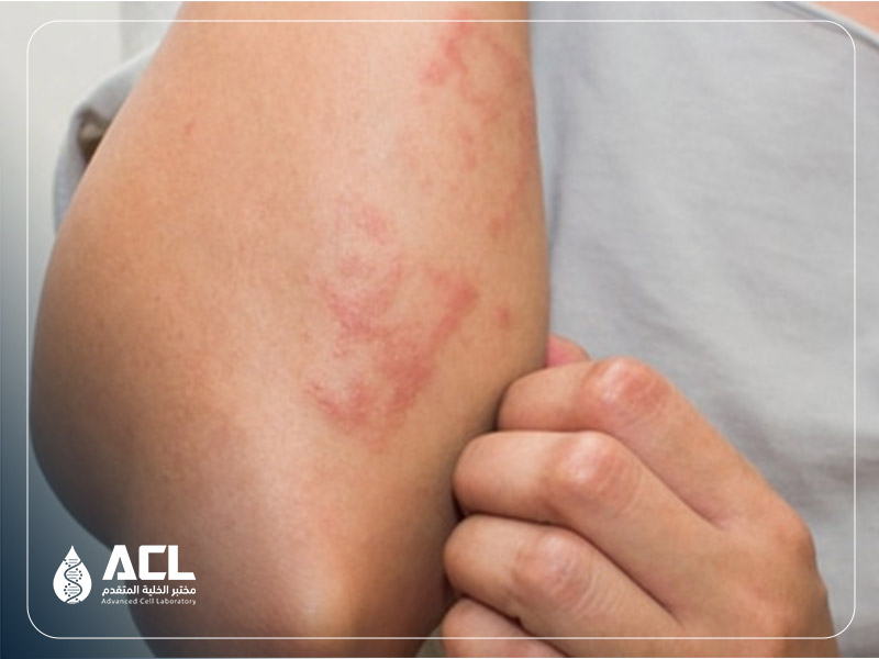 ما الفرق بين حساسية القمح وعدم تحمل الجلوتين؟