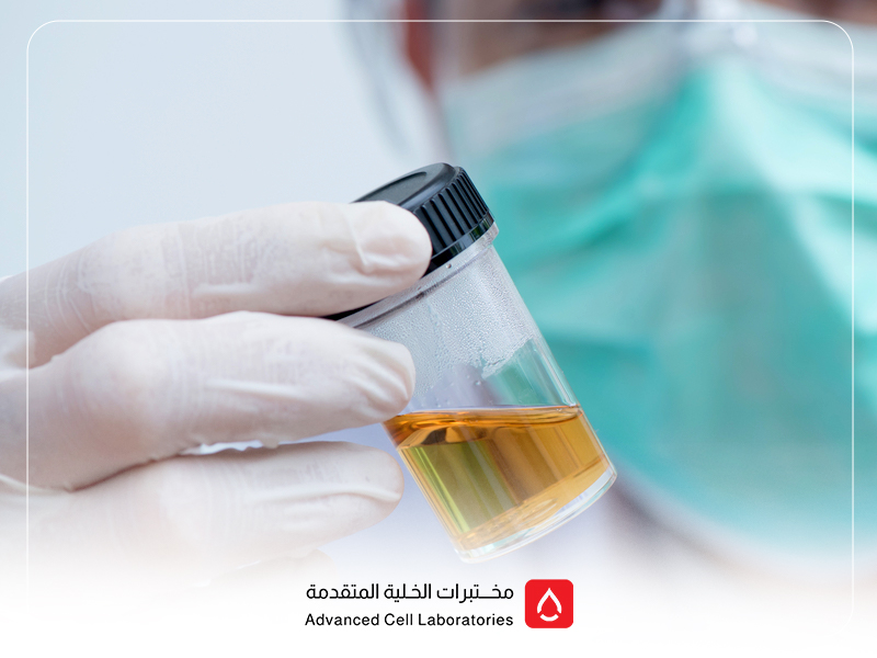 تحليل البول: دليل شامل لفهم نتائجه وأهميته