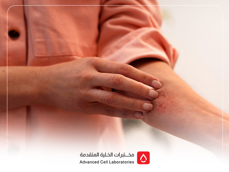 تحليل الحساسية: دليلك الشامل لفحص الحساسية في السعودية